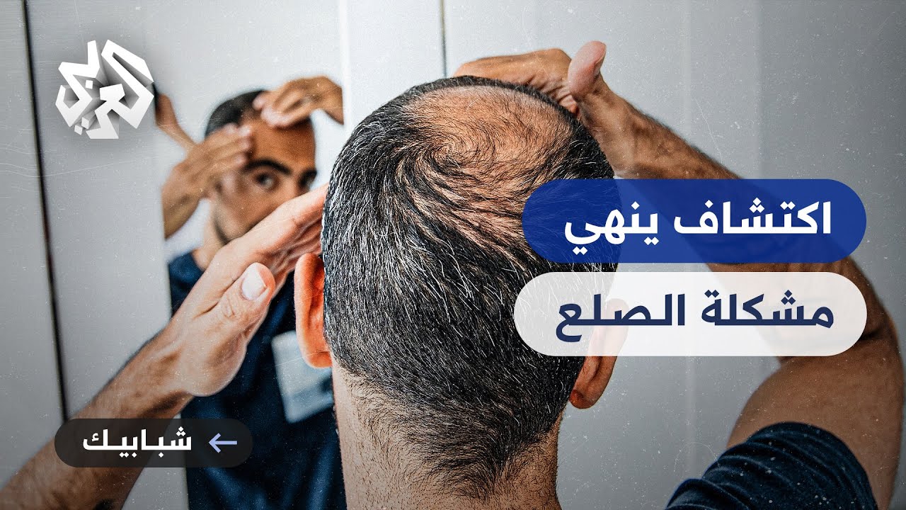 هل يستطيع العلم حل معضلة تساقط الشعر؟