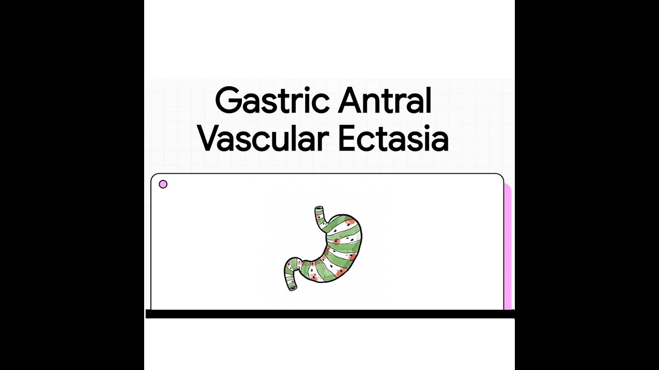 Gastric Antral Vascular Ectasia (GAVE) | Pathophysiology, Diagnosis & Management