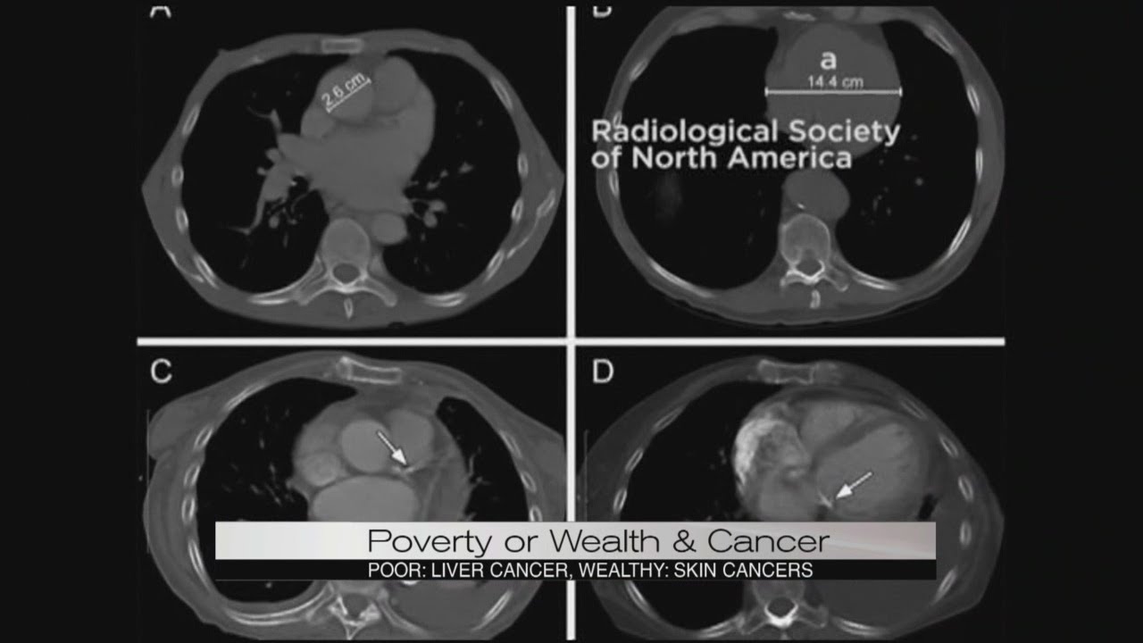 Poverty or Wealth Cancers