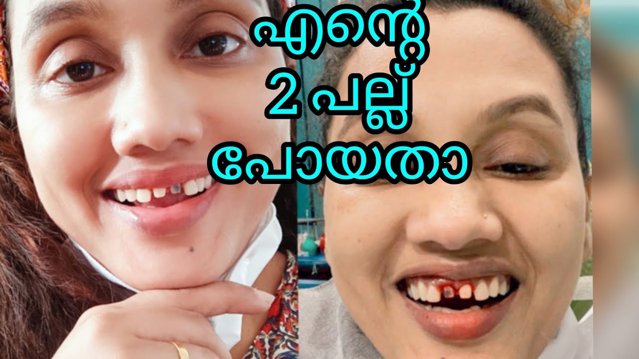 എന്റെ മുന്നിലെ 2 പല്ലു പോയി|My struggle|karimashilovernew