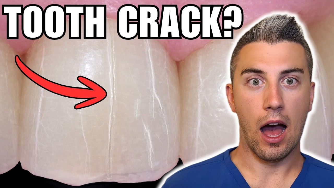 Do These Lines Mean Your Tooth Is Cracked?