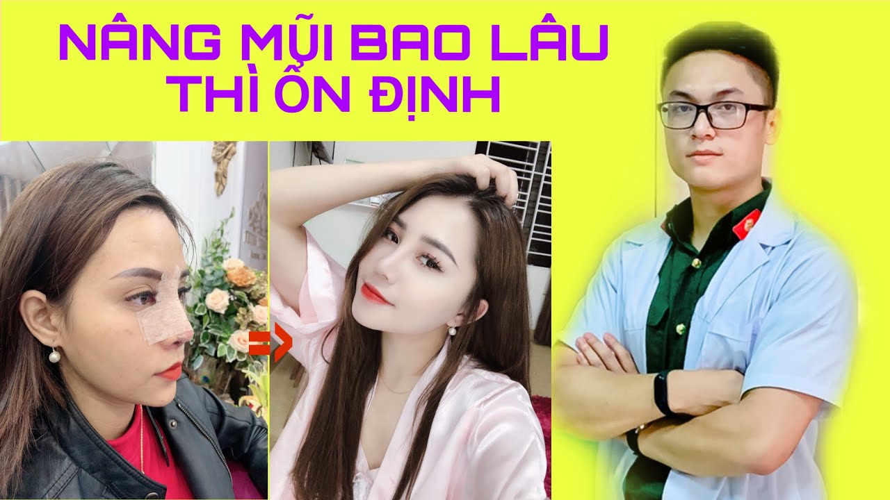 Bs Hoàng Long| Phẫu Thuật Nâng Mũi Bao Lâu Thì Ổn Định?