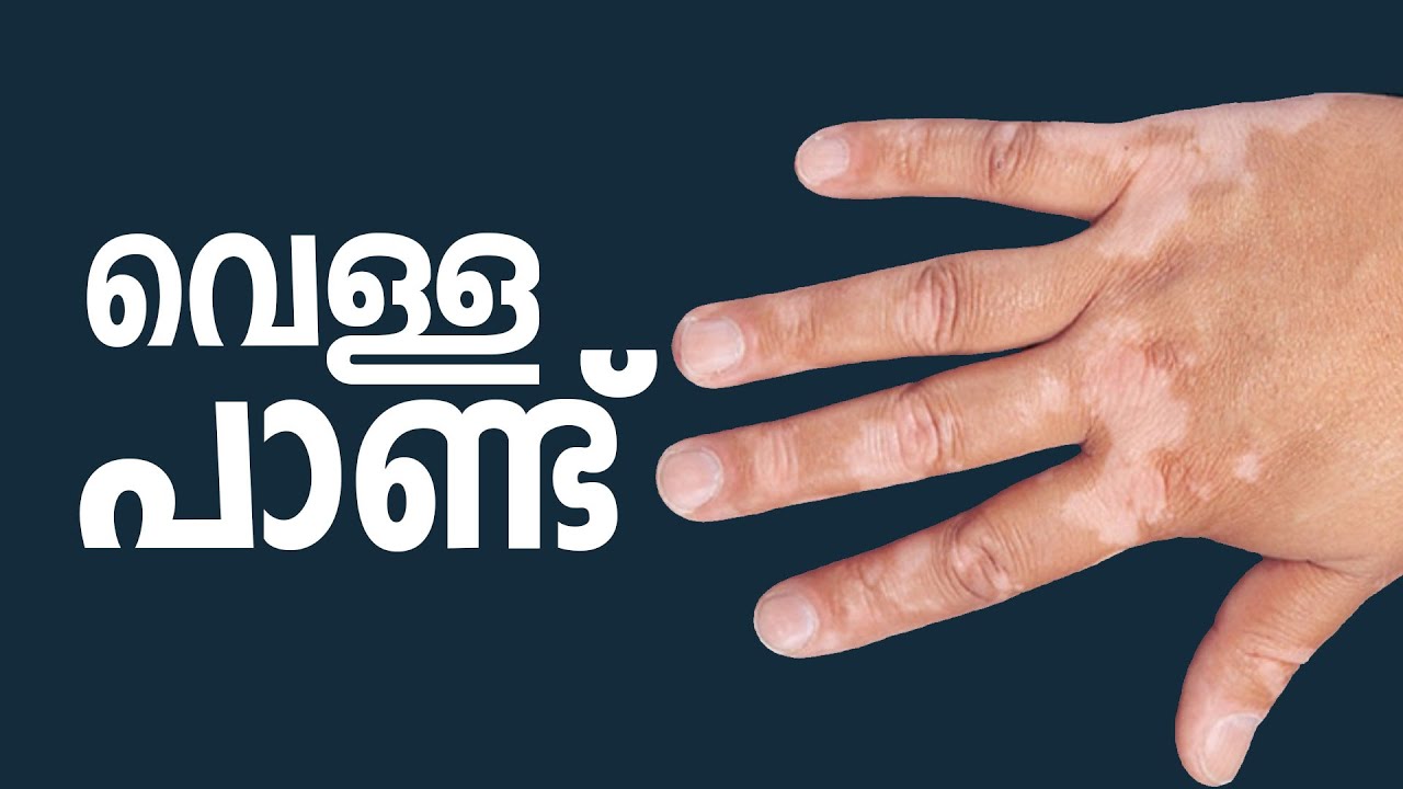 Vitiligo |വെള്ള പാണ്ട് |GOOD HEALTH |EP -123