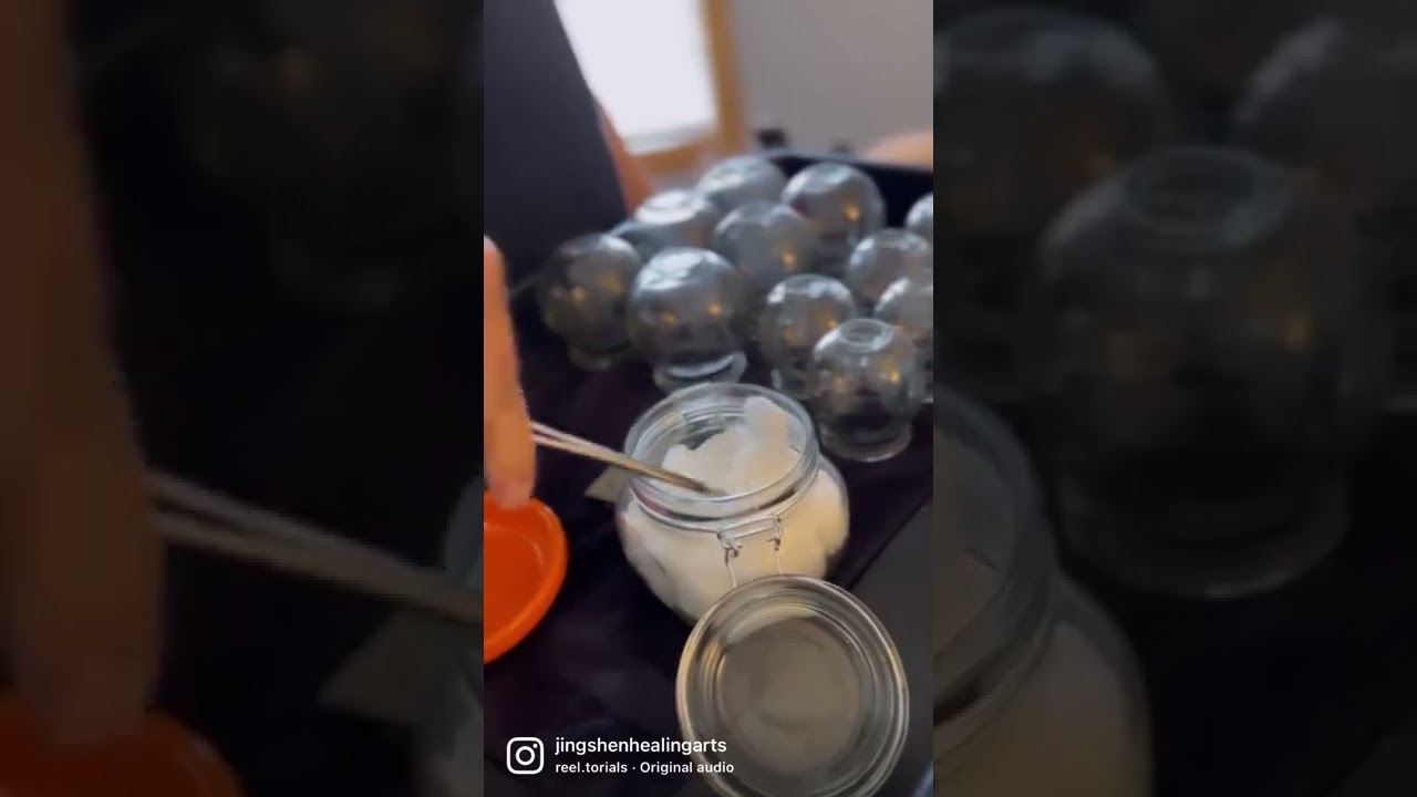 FIRE CUPPING THERAPY