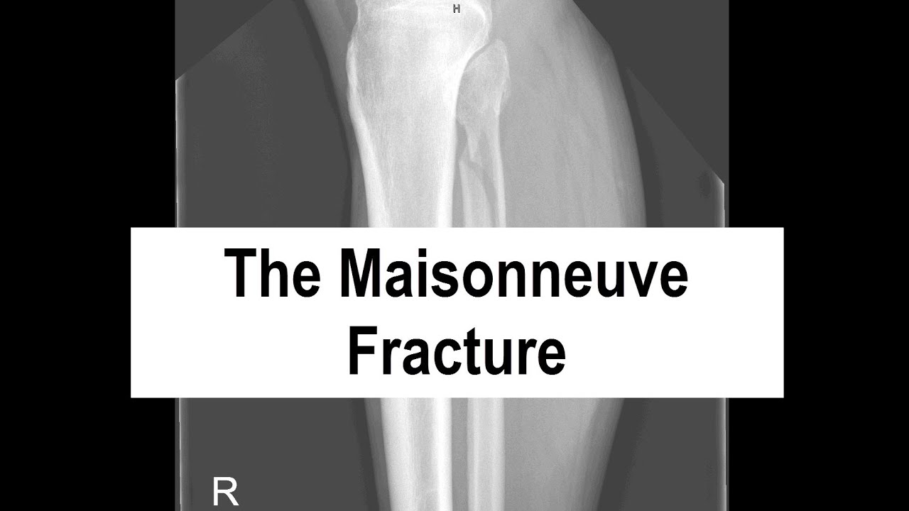 The Maisonneuve Fracture