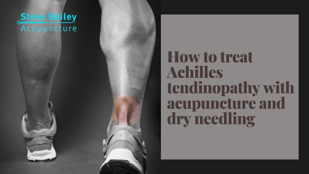 How to treat Achilles tendinopathy with acupuncture and dry needling