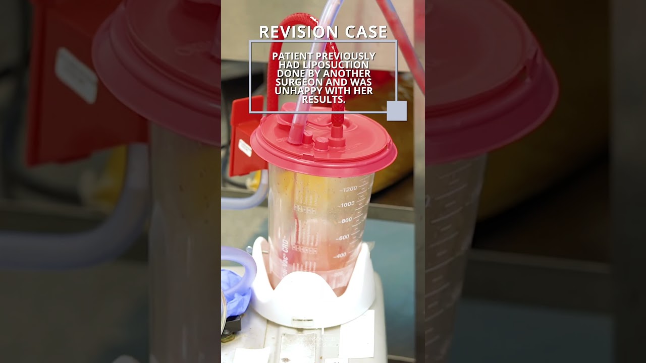 Liposukcja rewizyjna ramion | Dr Johnson C. Lee | Beverly Hills, Kalifornia
