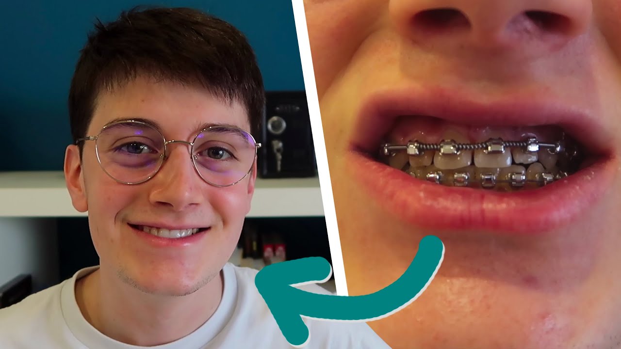 Pourquoi J'ai Porté un APPAREIL DENTAIRE Pendant 4 ANS ? (Ma Transformation)