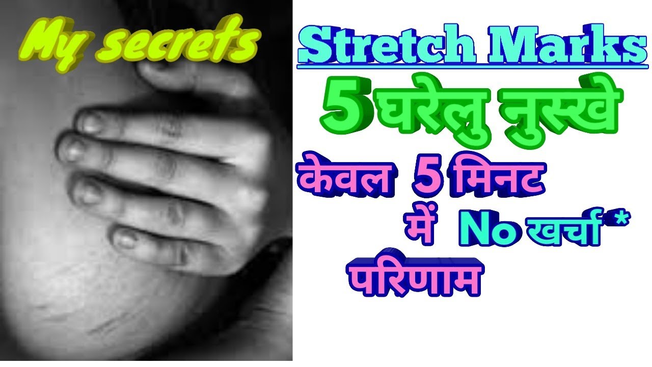 स्ट्रेच मार्क का केवल 5 मिनट में चमत्कारी परिणाम,  पुरुष एवं  महिलाओ दोनों के लिए,  Dr Shalini