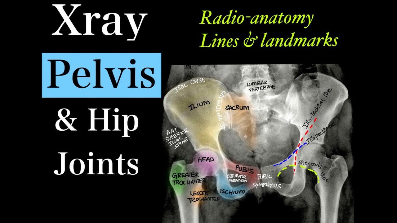 X-ray Pelvis & B/L hip l Anatomyl Viewsl Linesl Landmarksl Measurementsl Adult & Pediatric hip