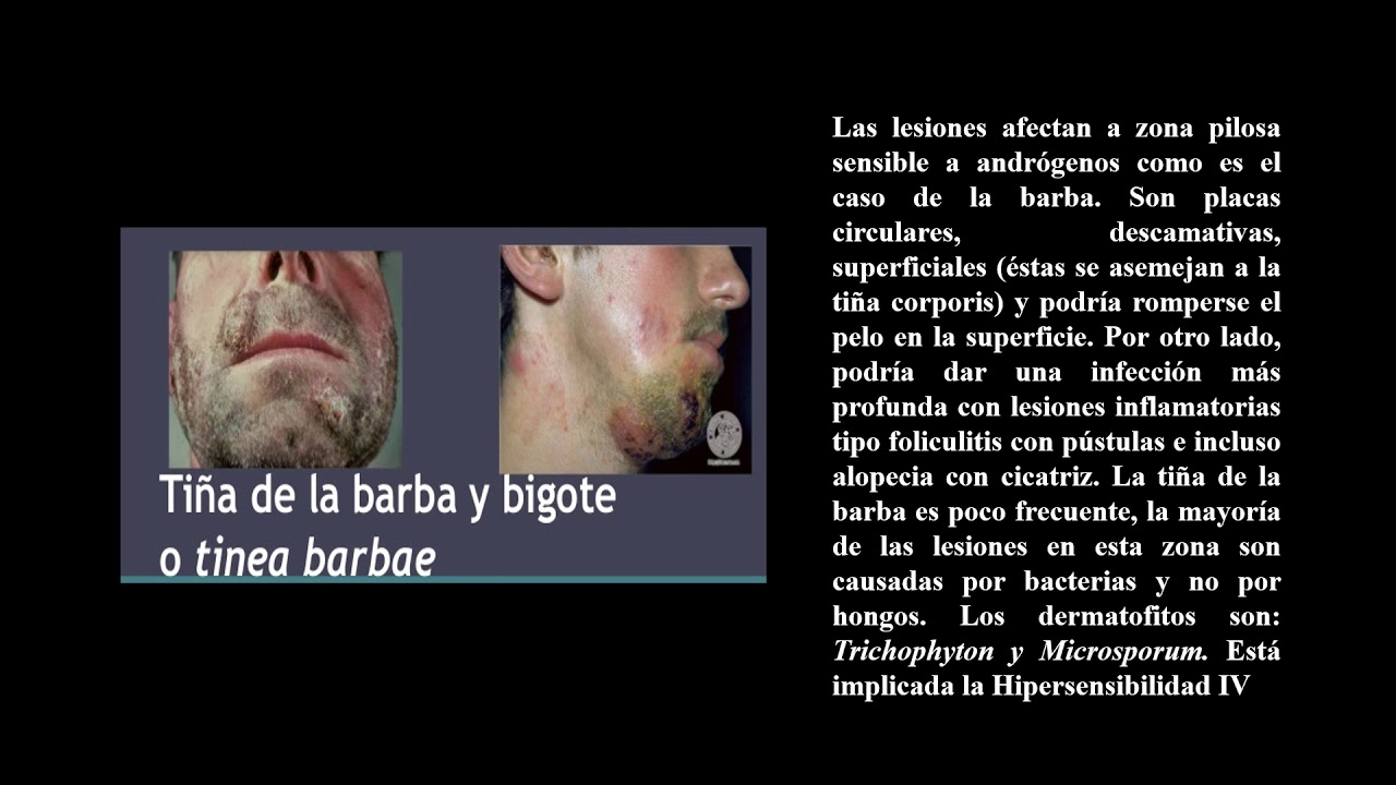 1  Dermatofitos