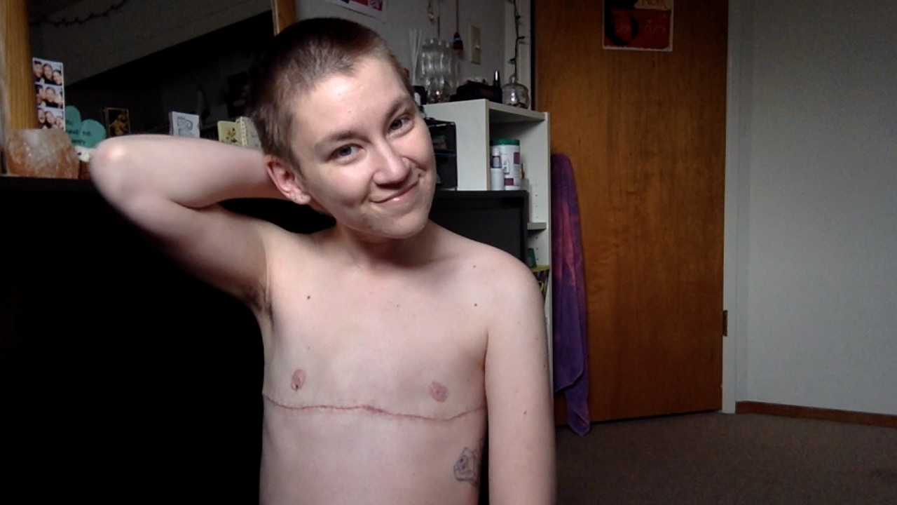 Top surgery - 1 month post op