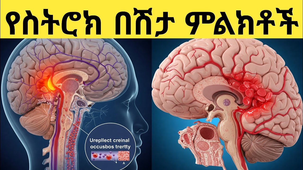 ስትሮክ ምንድን ነው,አይነቶቹ ምልክቶቹ,መንስኤው እና መከላከያ መፍትሄዎች| ስትሮከ በሽታ | Stroke cuses,types and prevention