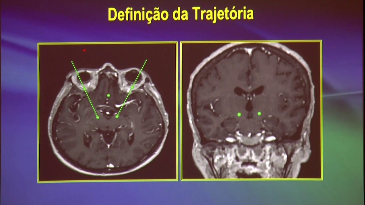 23 Neuromodula&ccedil;&atilde;o : Avan&ccedil;os no Tratamento Neurocir&uacute;rgico dos Dist&uacute;rbios do Movimento