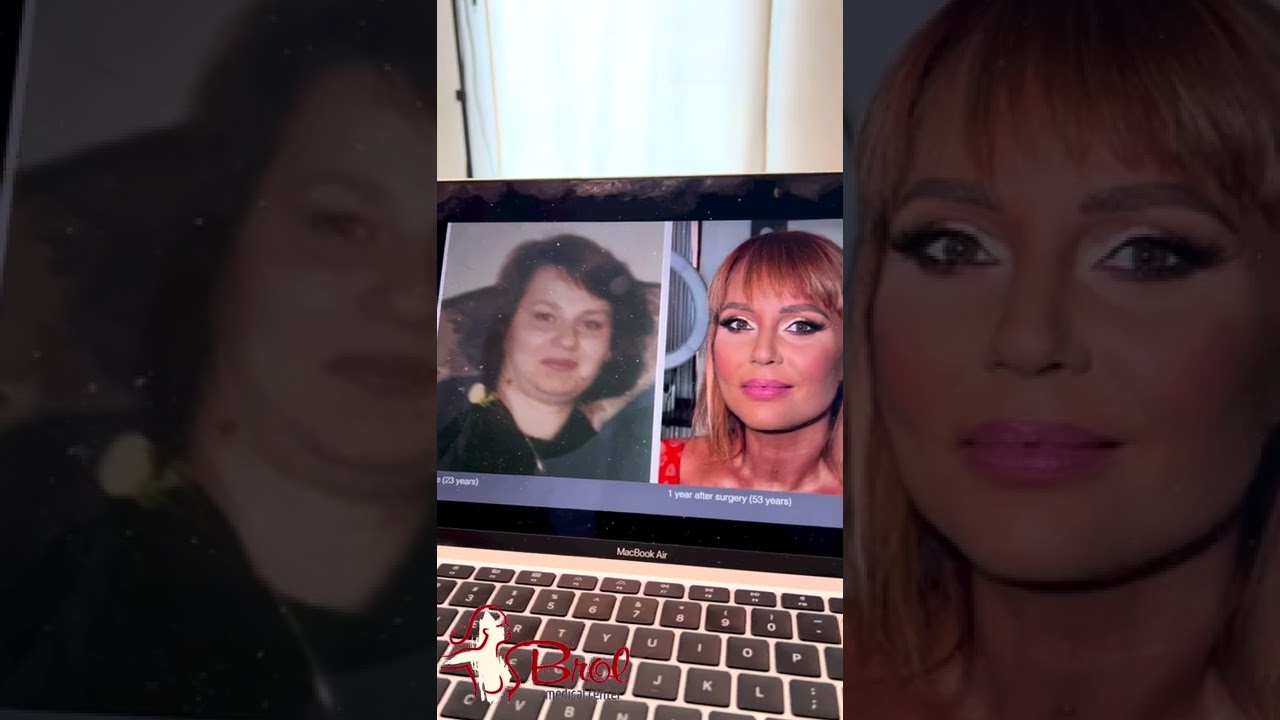 Lifting facial - inainte și dupa