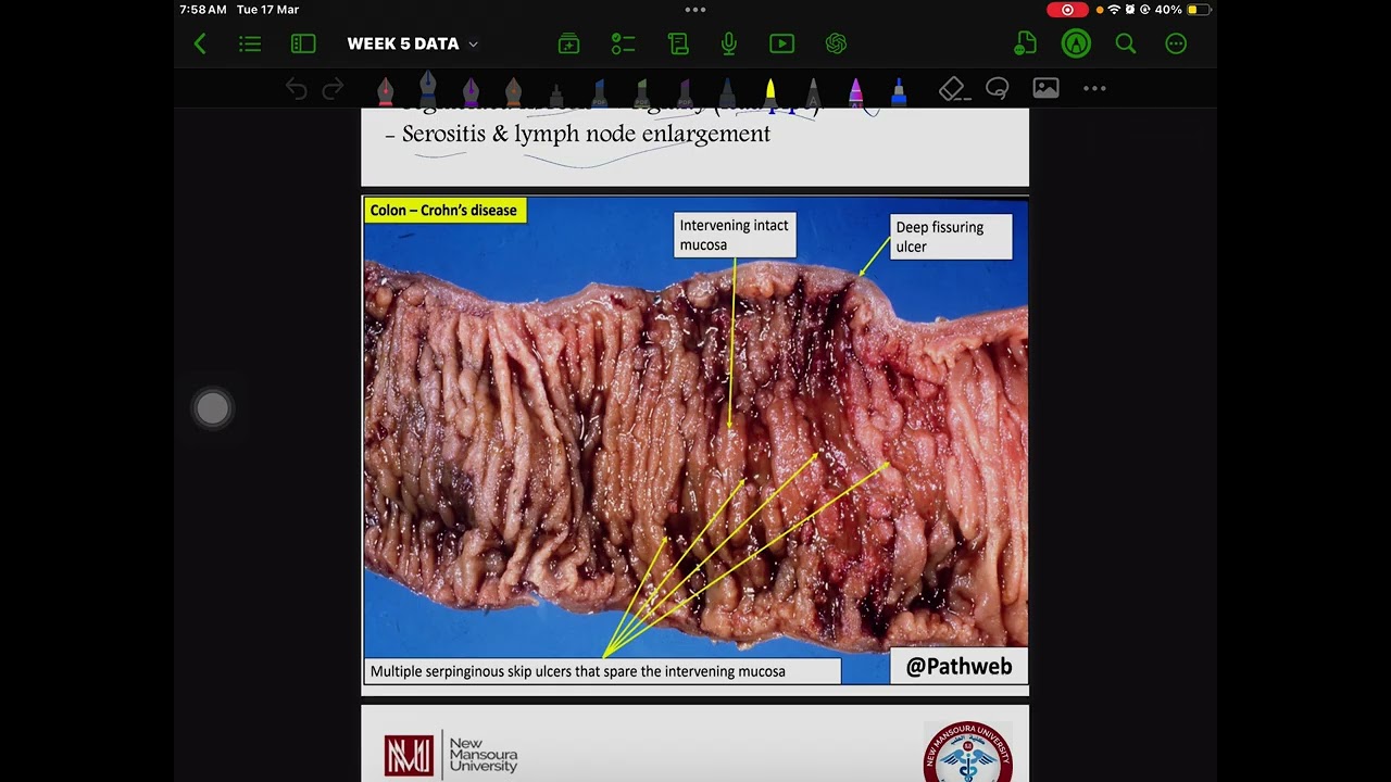   NMU Inflammatory bowel diseasesand dysentery