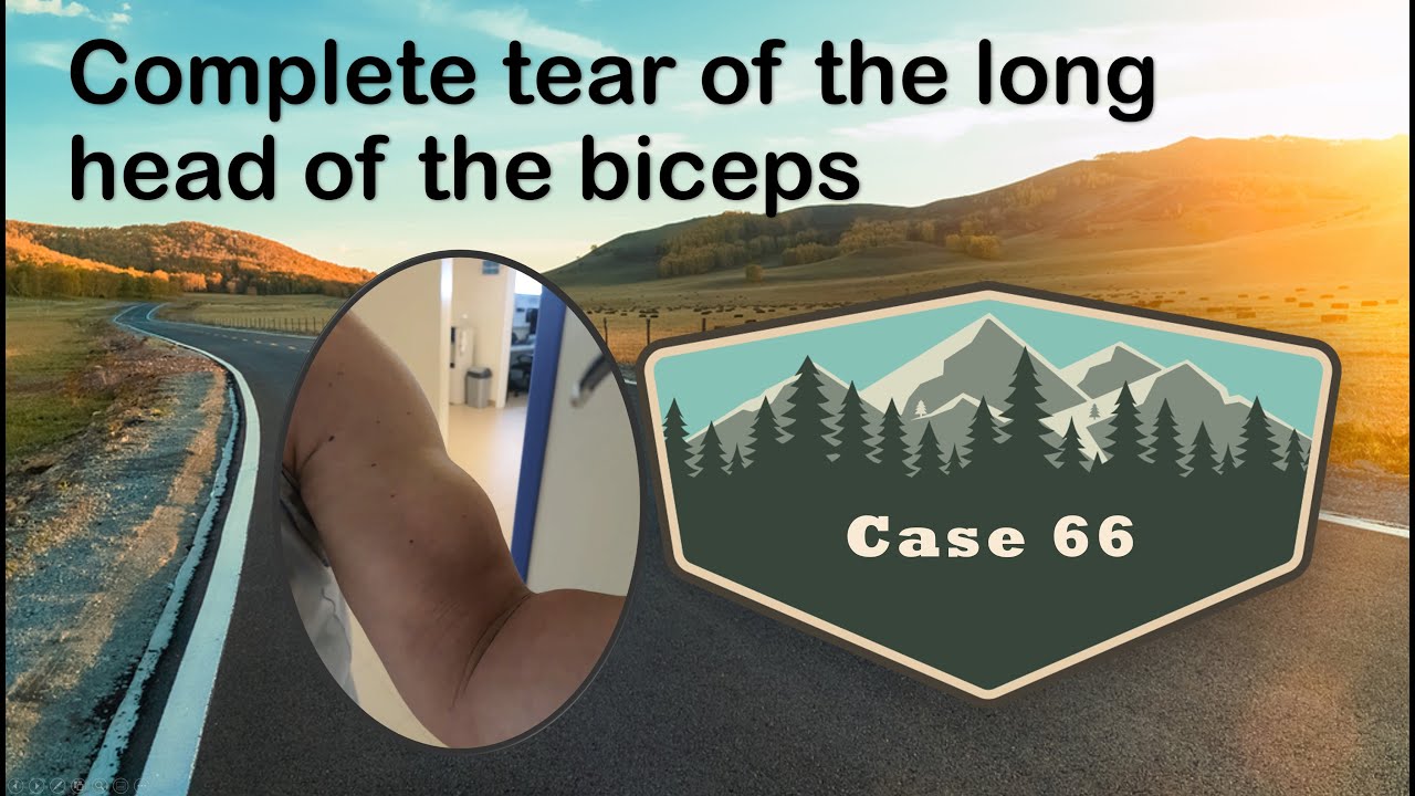 Long head of the biceps complete tear - shoulder case 66 ENG