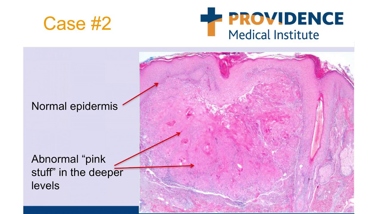 Providence Skin Cancer Lecture - June 13, 2018