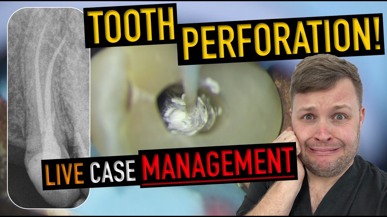 I Perforated a Tooth… Here’s Exactly How I Fixed It 😬 (UL5 Root Canal)