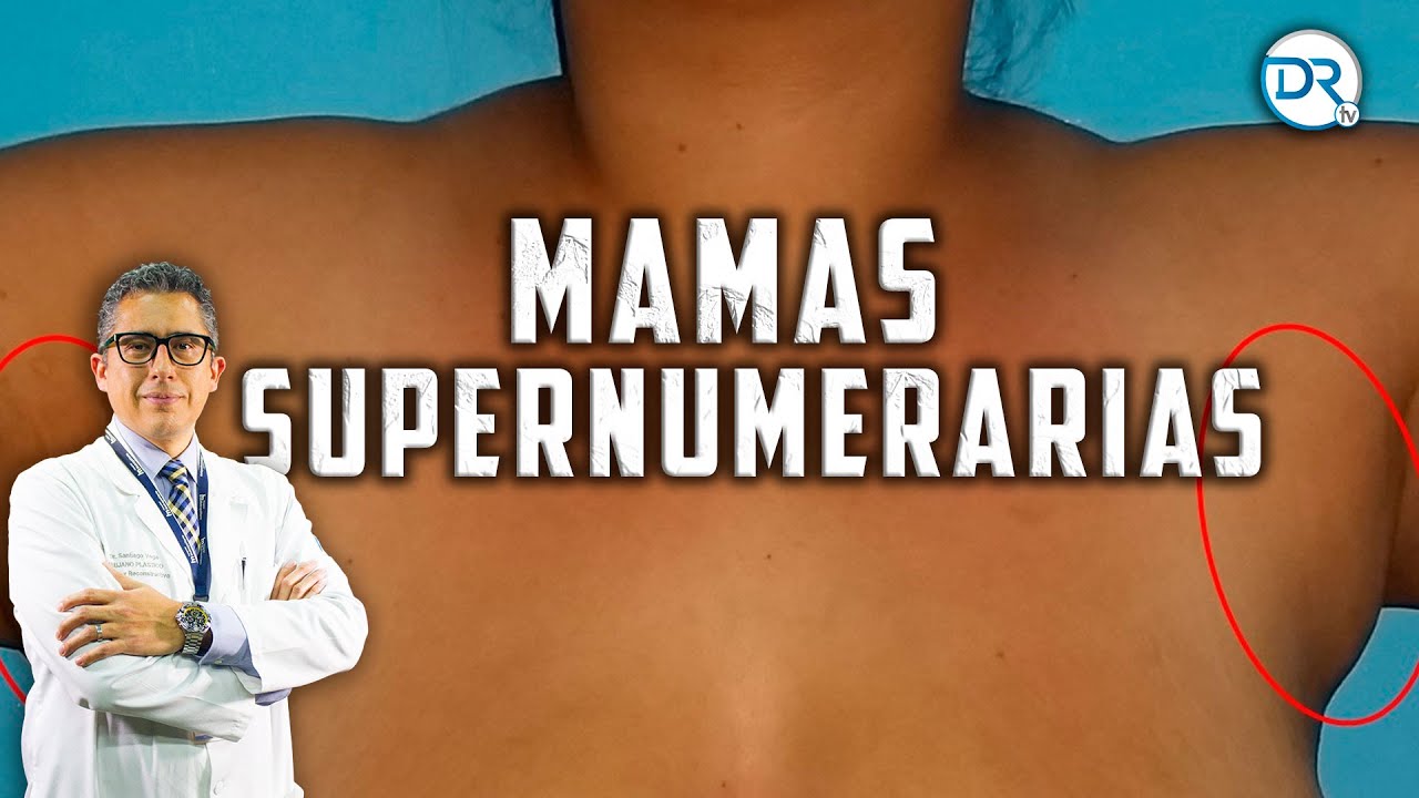 ¿Cómo eliminar las Mamas Supernumerarias? DrTv RTU