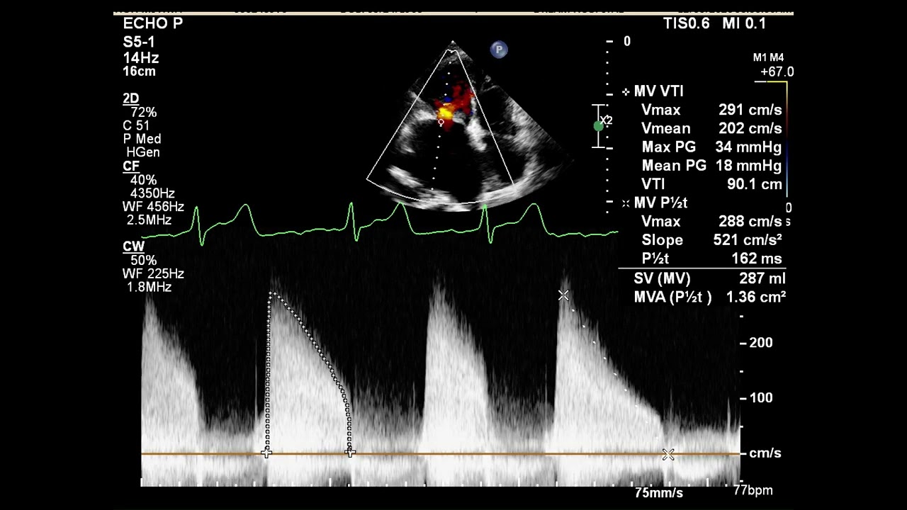 [Echo Case Review]Severe MS