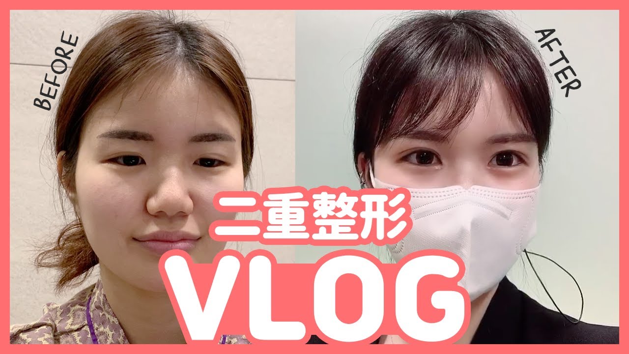 韓国美容整形外科のスタッフが二重手術を受けました！リアルな整形レポ公開