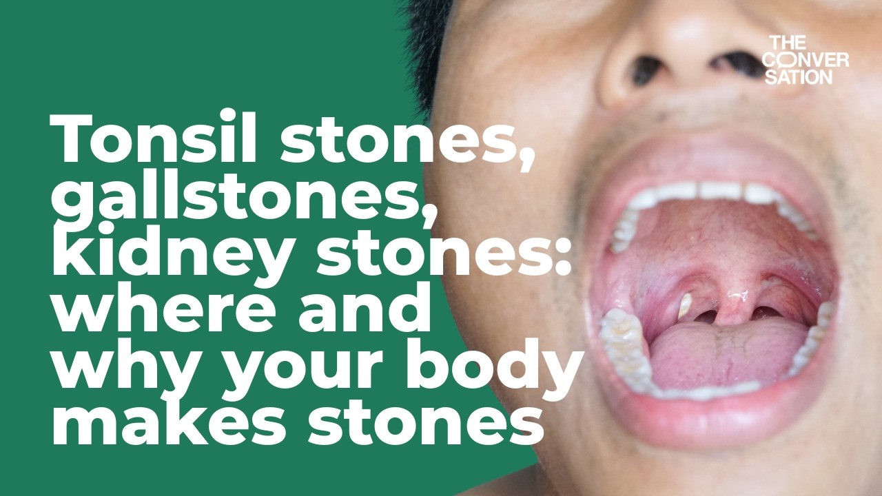 Tonsil stones, gallstones, kidney stones: where and why your body makes stones