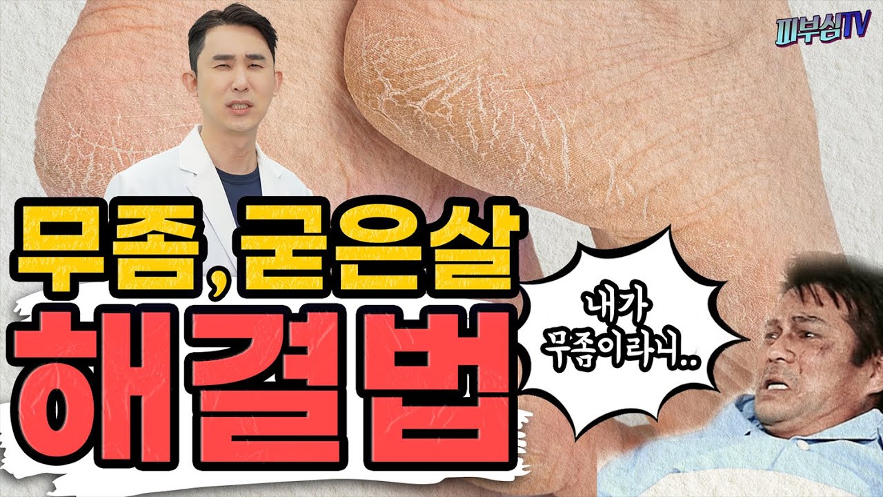 무좀 굳은살 해결법! - 내가 무좀이라니..! [피부과전문의 피부심]