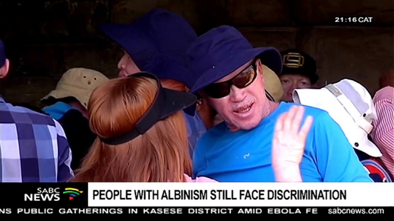 People with albinism still face discrimination