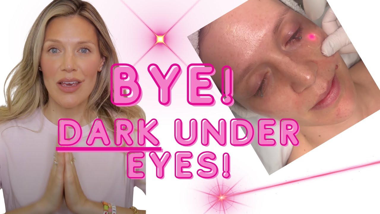 I Tried ND YAG Laser for Under Eye Veins and WOW!