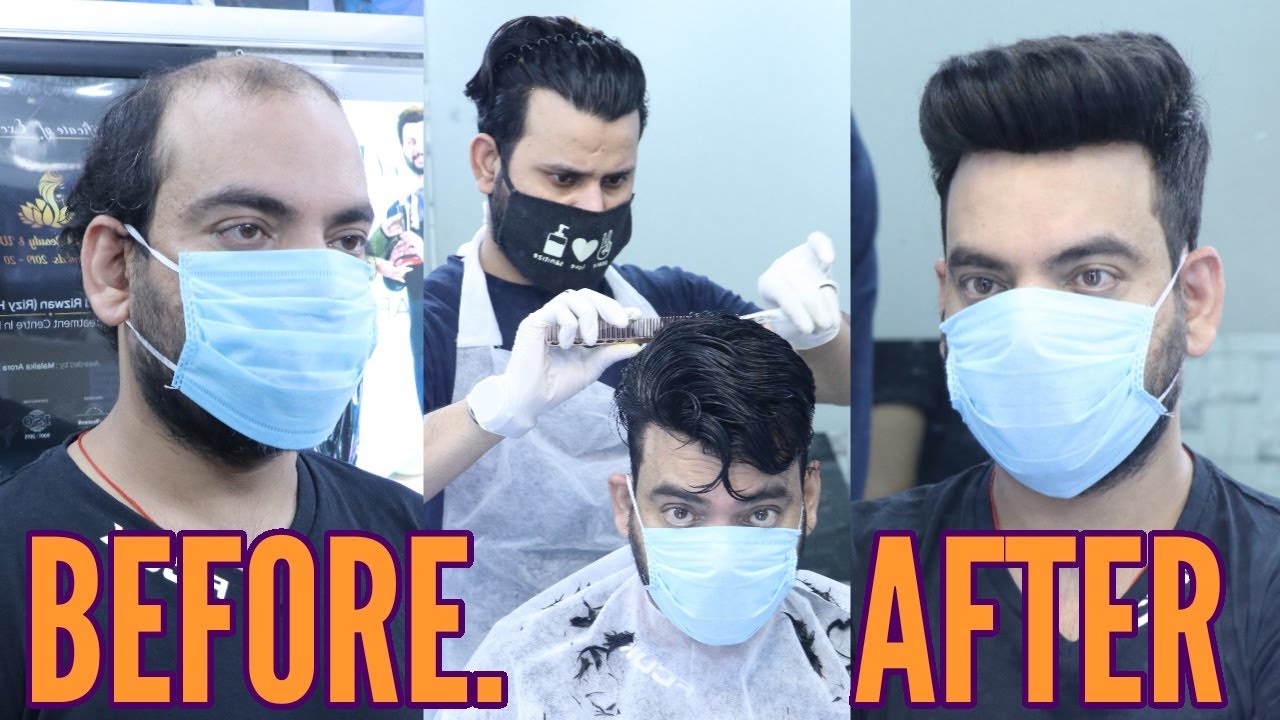Men's Hair Wig | Hair Patches In India | Non Surgical Hair Fixing | No Pain No Side Effects | wigs |