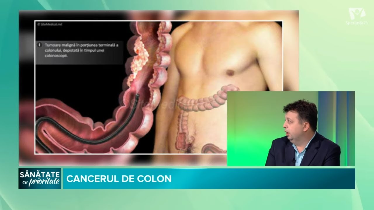 CANCERUL DE COLON | Dr. BOGDAN DIACONESCU | Sănătate cu prioritate | Raluca Mateescu