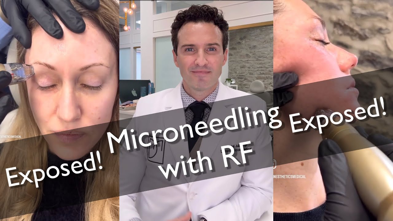 Microneedling & Radio-frequency (Myths & Truths) What you should know