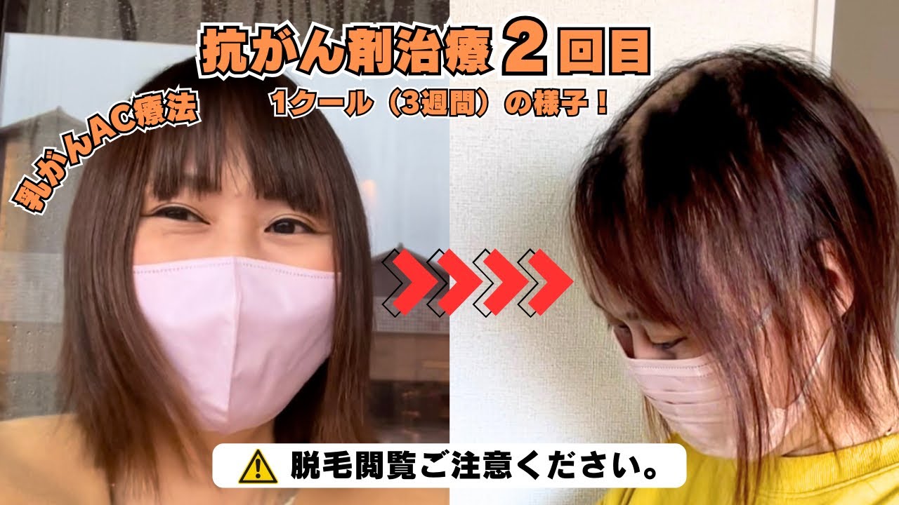 【乳がんAC療法2/4】抗がん剤治療2回目-1クール(3週間)の様子！※脱毛閲覧ご注意ください