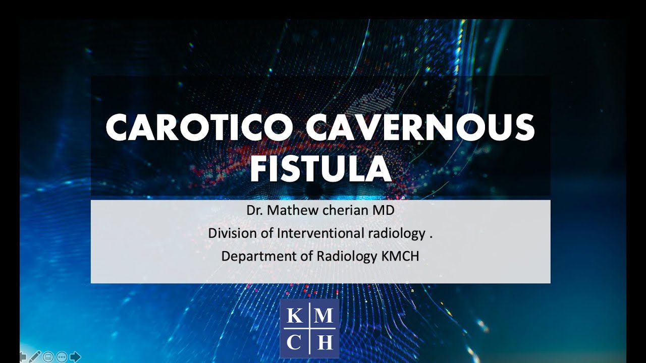 CAROTICO CAVERNOUS FISTULA