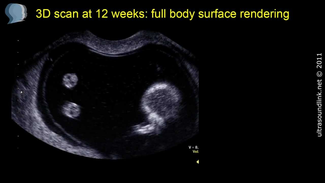 3D scan at 12 weeks: fetal body and legs