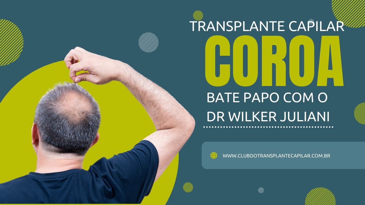 TRANSPLANTE CAPILAR- REGIÃO DA COROA (COM O DR WILKER JULIANI) - 500 REAIS DE DESCONTO NA CIRURGIA!!