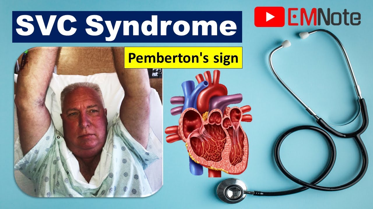 Superior Vena Cava (SVC) Syndrome
