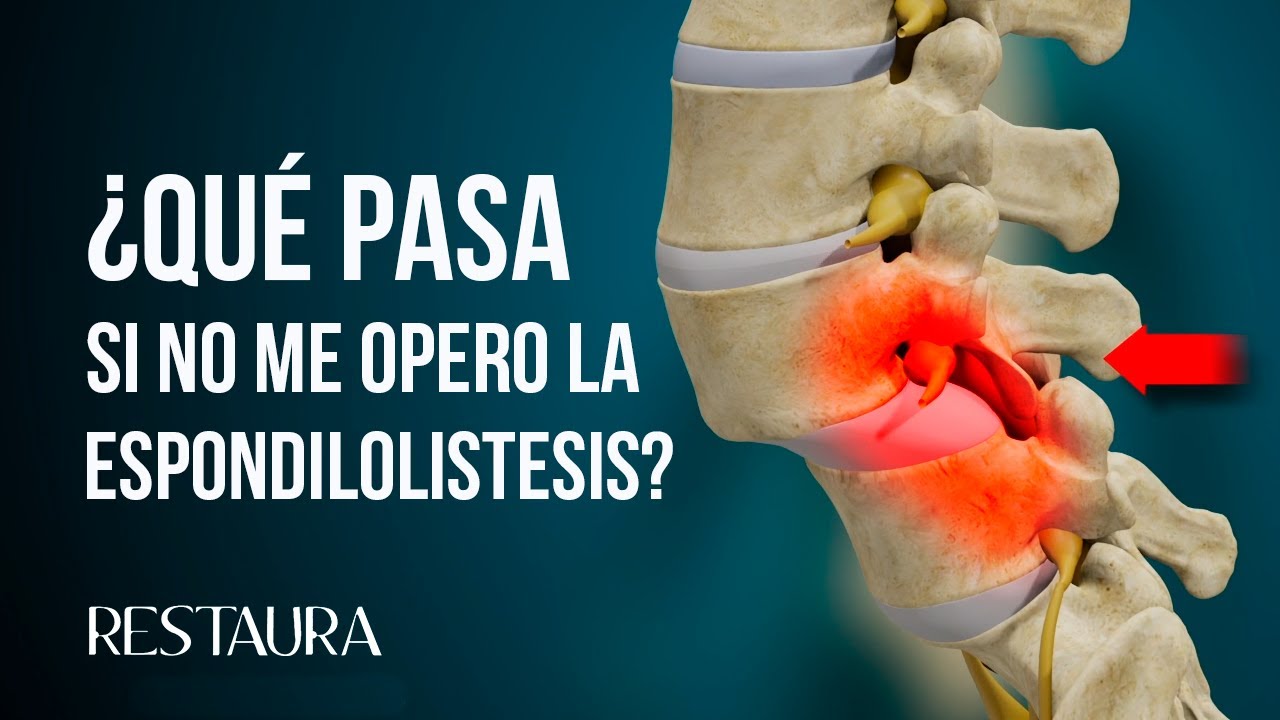 &iquest;Qu&eacute; pasa si no me opero la espondilolistesis?