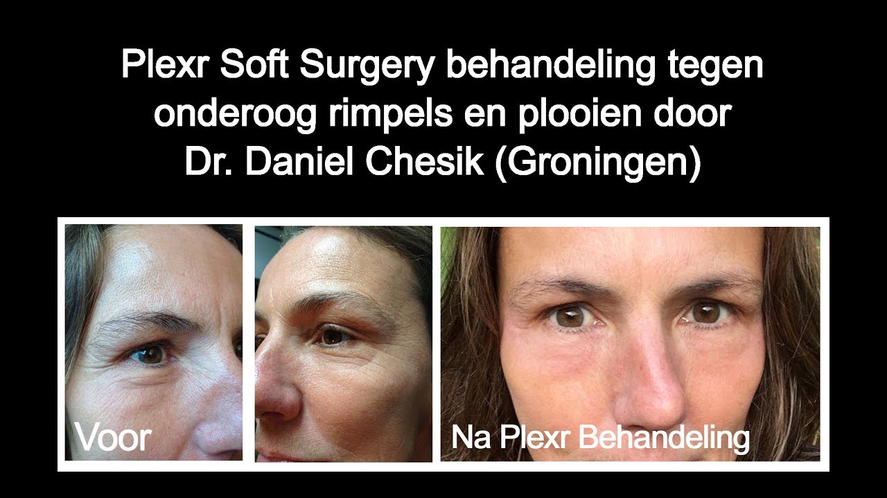 Onderoog Rimpels en Wallen Behandelen - Plexr door Dr. Daniel Chesik