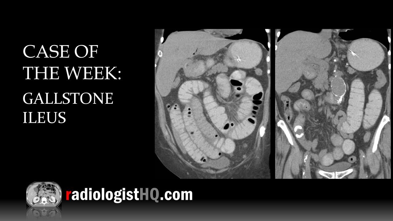 Case of the Week: Gallstone Ileus (X-ray & CT)