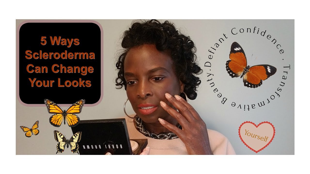 How Scleroderma Can Change A Person's Looks!!