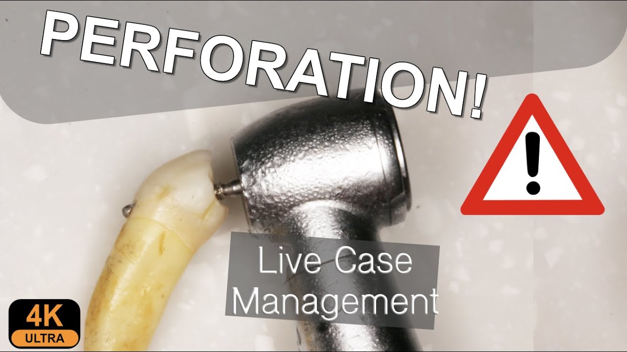 TOOTH PERFORATION MANAGEMENT | 4K Resolution
