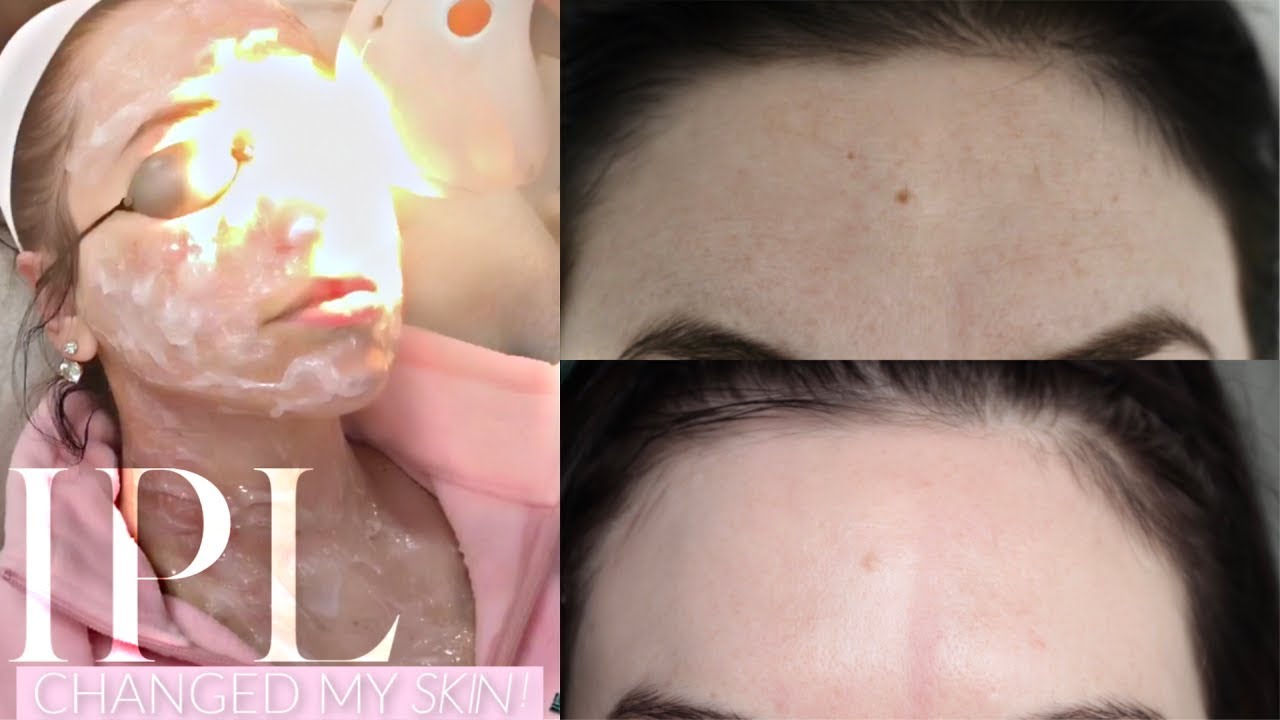 IPL The Facial that changed my skin !