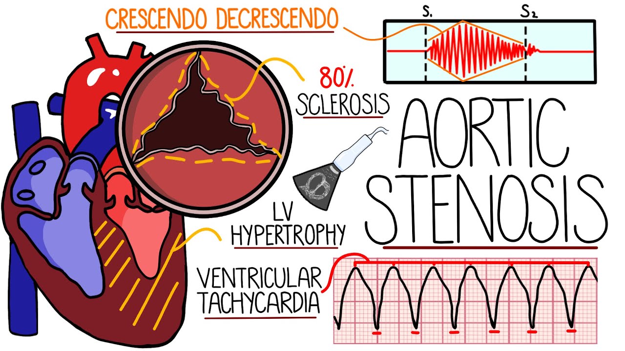 Aortic Stenosis Explained in 10 Minutes (With Heart Murmur Sound)