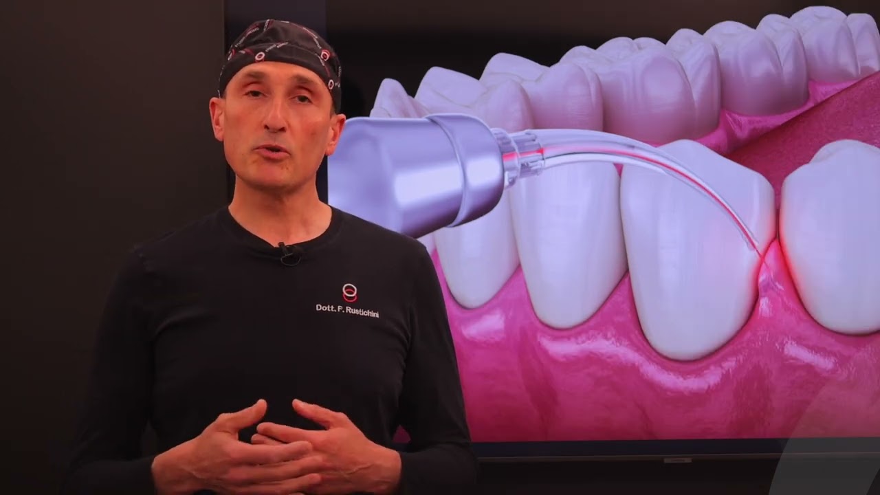 Utilizzo del  Laser in odontoiatria - Dr Filippo Rustichini Dentista