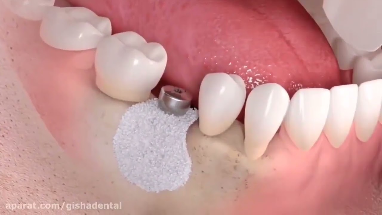 پیوند استخوان برای ایمپلنت دندان _ دکتر عزیز گشاده رو