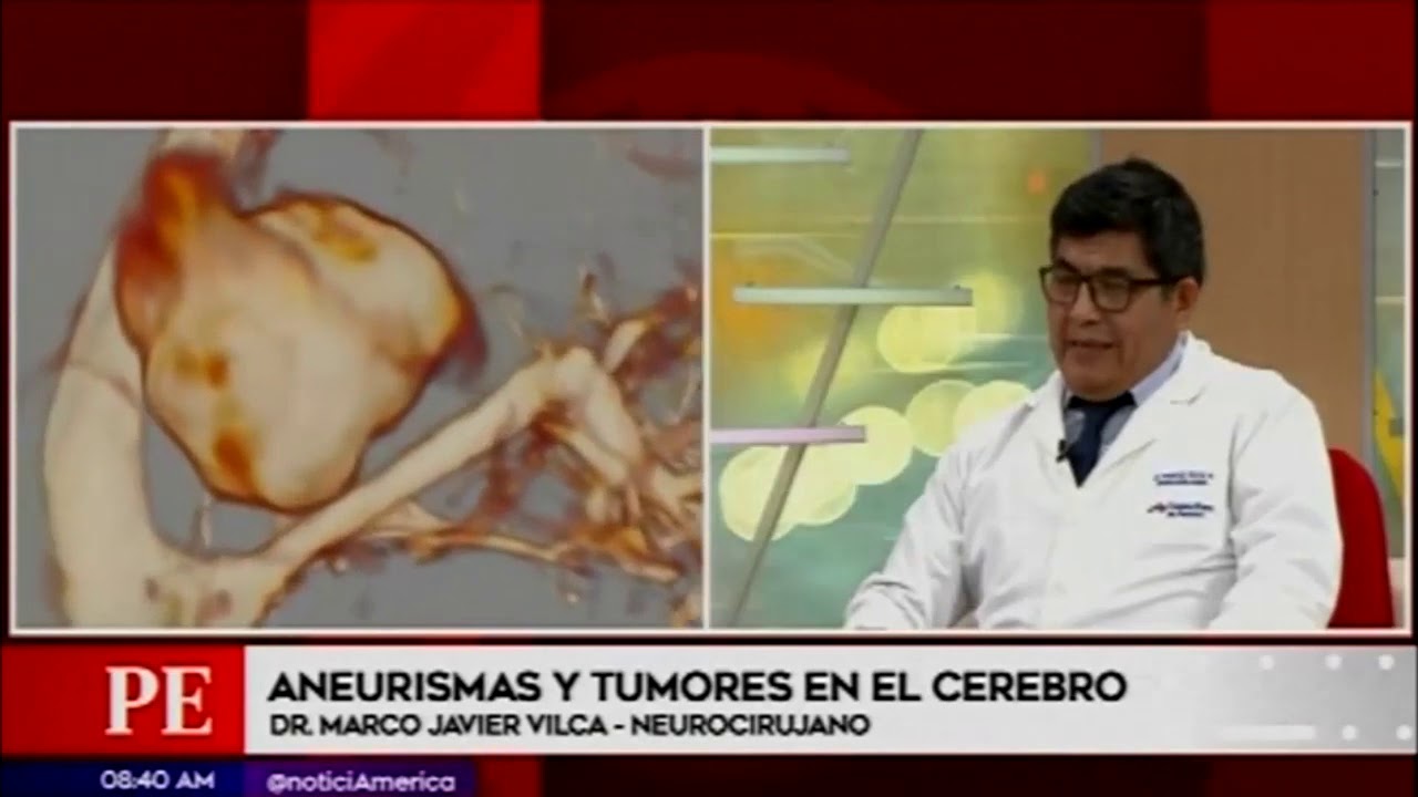 Dr. Marcos Vilca - Aneurismas y Tumores en el Cerebro - Sanamente