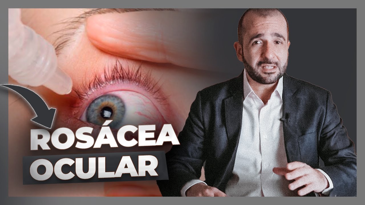 ROSÁCEA OCULAR : O QUE É E COMO TRATAR?
