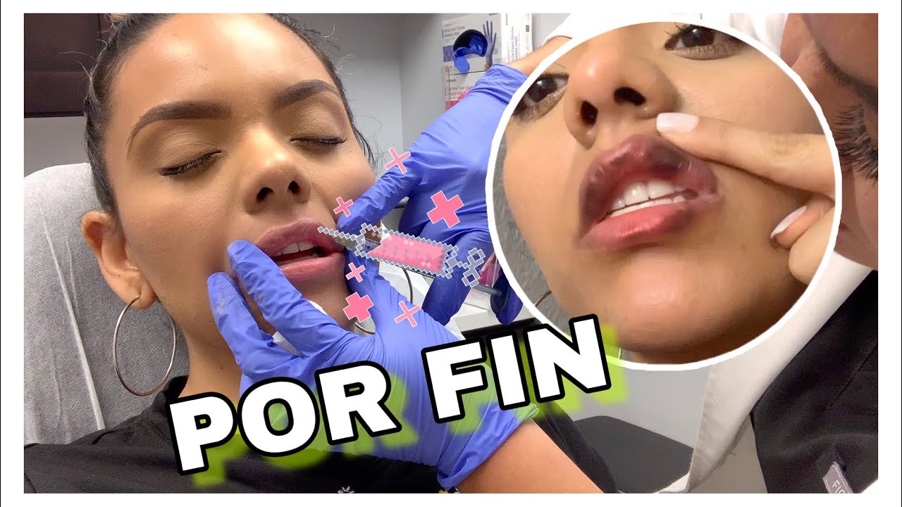 LIP FILLERS - INYECCIONES DE LABIOS CON ACIDO HIALURONICO MI EXPERIENCIA